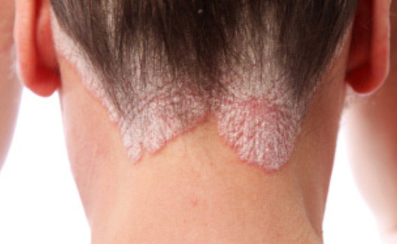 Psoriasis 1 psoriasis1