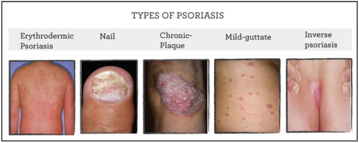 psoriasis plastic surgery