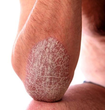 psoriasis3