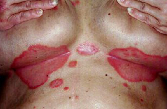 psoriasis4