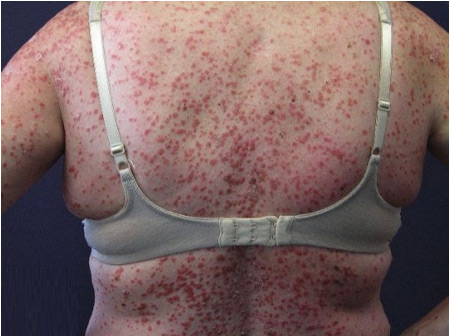 psoriasis plastic surgery melyik testkrém jobb a pikkelysömörhöz