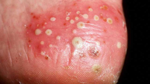 psoriasis6