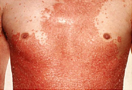 psoriasis7